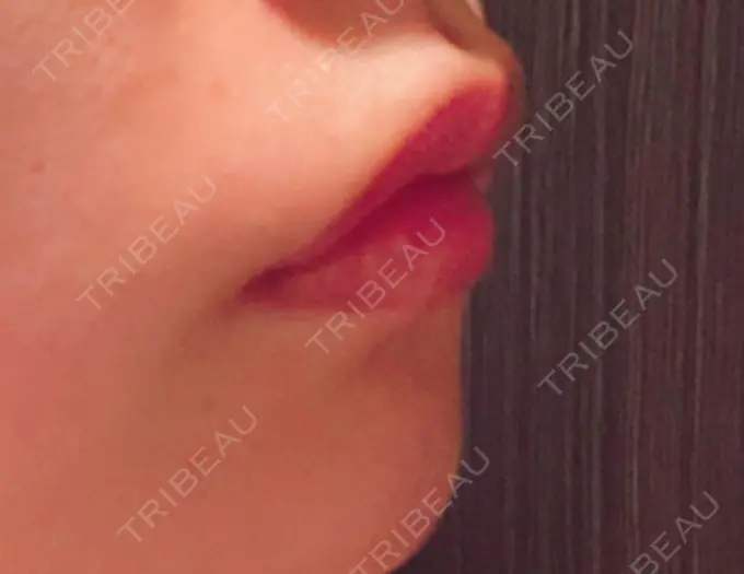 口角挙上 宇都宮竹内クリニック DAY 22 メイン用