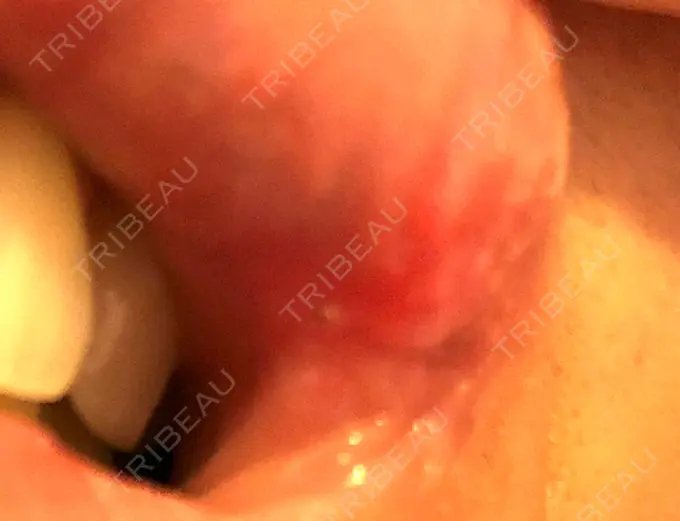 口角挙上 宇都宮竹内クリニック DAY 50 メイン用