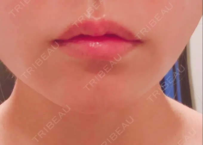 口角挙上 宇都宮竹内クリニック DAY 55 メイン用