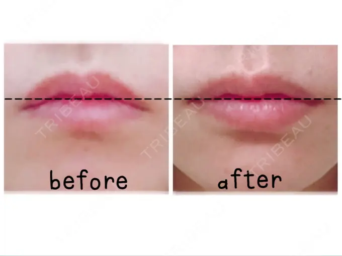 口角挙上 宇都宮竹内クリニック DAY 70 メイン用