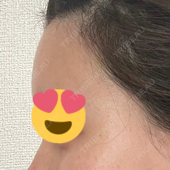 脂肪注入（額） / 脂肪注入（輪郭） 牧野美容クリニック DAY 13 メイン用