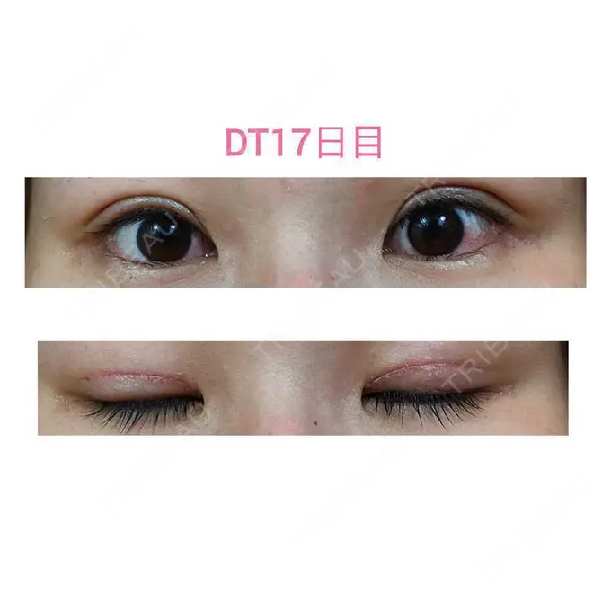 二重切開 / 眼瞼下垂（切開） 城本クリニック 福岡院 DAY 17 メイン用