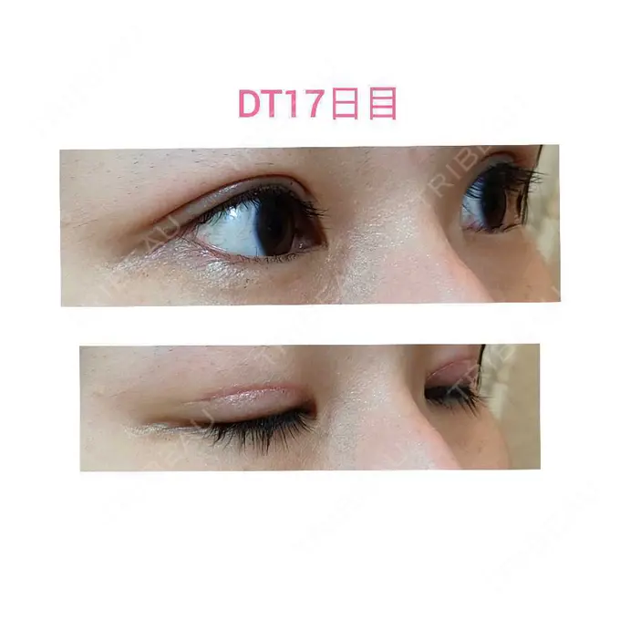 二重切開 / 眼瞼下垂（切開） 城本クリニック 福岡院 DAY 17 メイン用