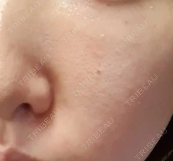 ベビーコラーゲン CLASSY 仙台美容外科・美容皮膚科 DAY 1 メイン用