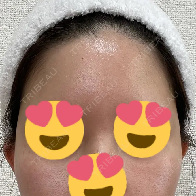 脂肪注入（額） / 脂肪注入（輪郭） 牧野美容クリニック DAY 16 メイン用