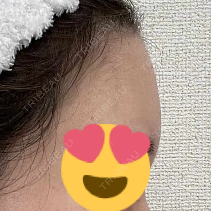 脂肪注入（額） / 脂肪注入（輪郭） 牧野美容クリニック DAY 16 メイン用
