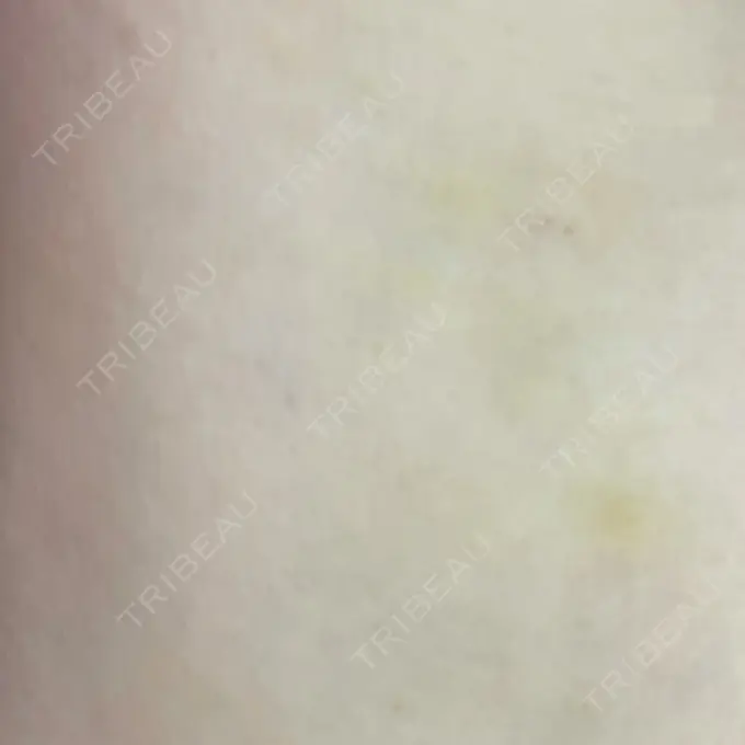 脂肪注入（額） / 脂肪注入（輪郭） 牧野美容クリニック DAY 16 メイン用