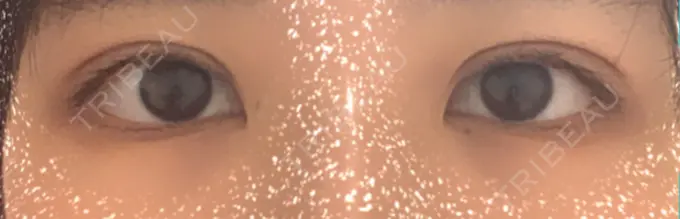 二重埋没 ハナビューティークリニック DAY 28 メイン用