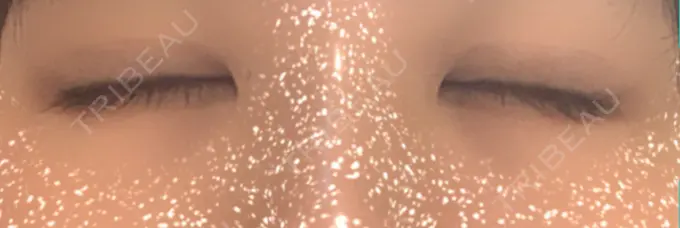 二重埋没 ハナビューティークリニック DAY 28 メイン用