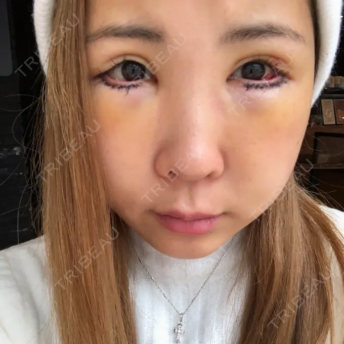 目尻切開 / タレ目形成・グラマラスライン（切開） 品川美容外科 横浜院（※品川スキンクリニック提携） DAY 2 メイン用