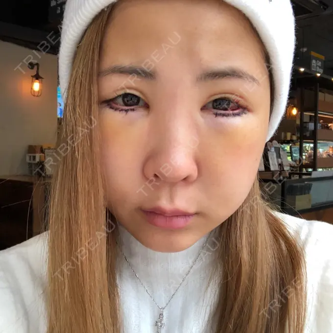 目尻切開 / タレ目形成・グラマラスライン（切開） 品川美容外科 横浜院（※品川スキンクリニック提携） DAY 2 メイン用