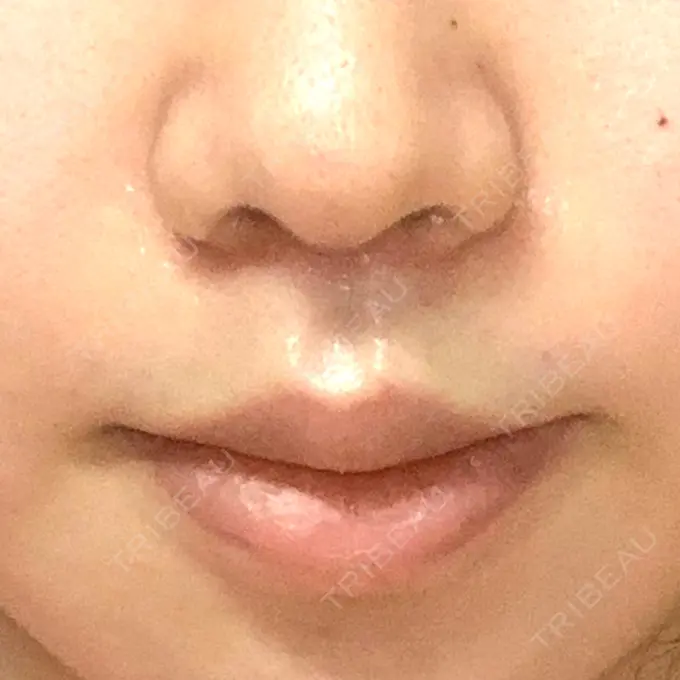 人中短縮 / ボトックス（口角） 新宿ラクル美容外科クリニック 新宿院 DAY 25 メイン用