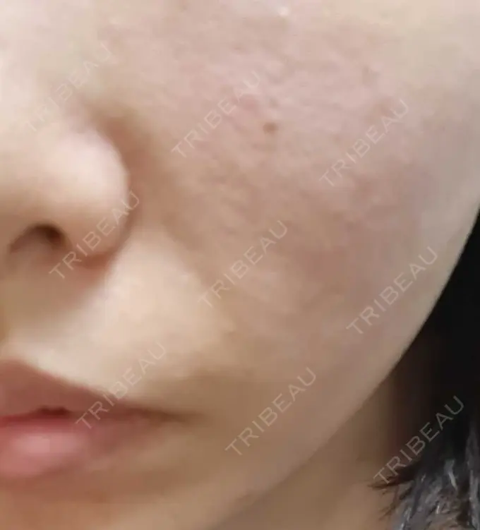 ベビーコラーゲン CLASSY 仙台美容外科・美容皮膚科 DAY 3 メイン用