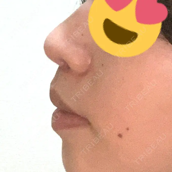 人中短縮 / ボトックス（口角） 新宿ラクル美容外科クリニック 新宿院 DAY 25 メイン用