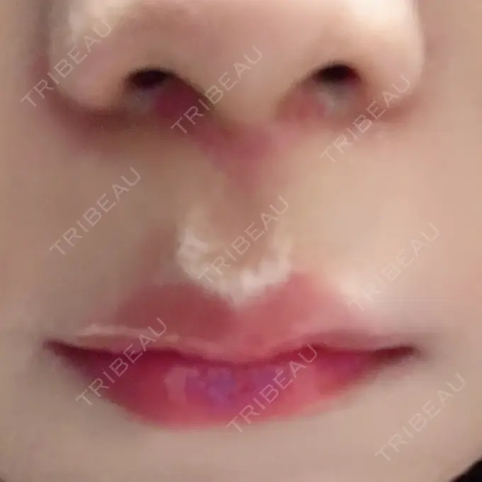 人中短縮 新宿ラクル美容外科クリニック 新宿院 DAY 85 メイン用