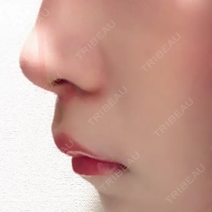 人中短縮 新宿ラクル美容外科クリニック 新宿院 DAY 85 メイン用