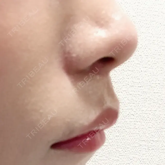 人中短縮 新宿ラクル美容外科クリニック 新宿院 DAY 85 メイン用