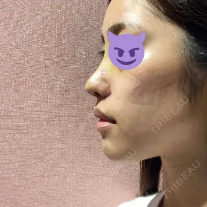 鼻中隔延長（切開） / 小鼻縮小（切開） みずほクリニック DAY 5 メイン用