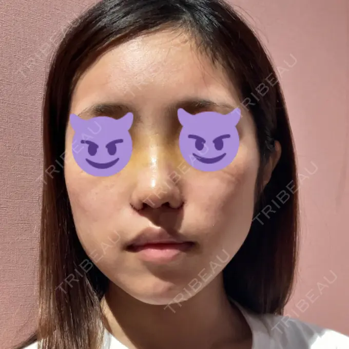 鼻中隔延長（切開） / 小鼻縮小（切開） みずほクリニック DAY 5 メイン用