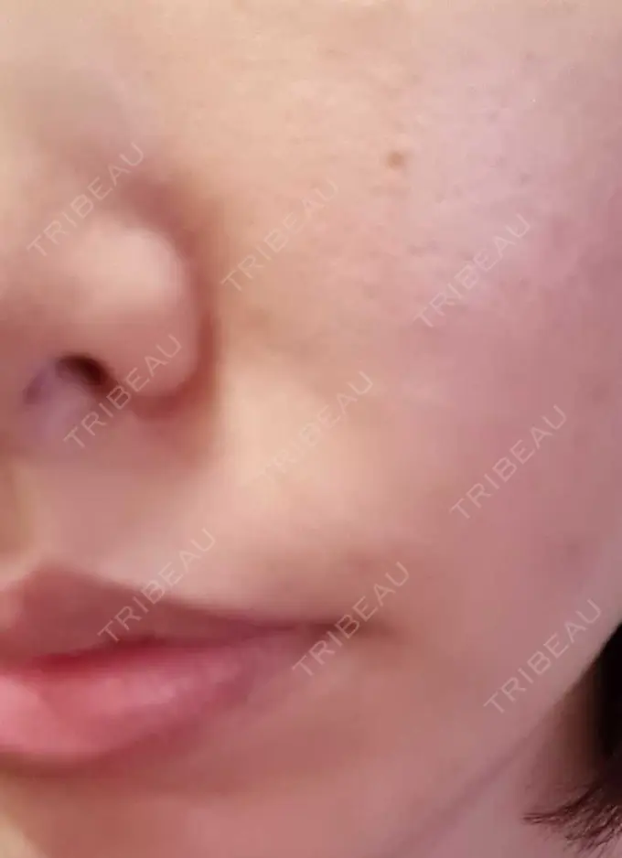 ベビーコラーゲン CLASSY 仙台美容外科・美容皮膚科 DAY 7 メイン用