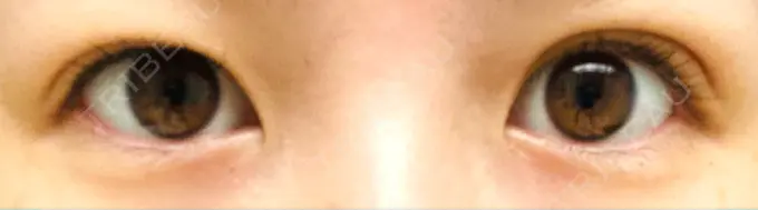 二重埋没 湘南美容クリニック 東京蒲田院 AFTER メイン用