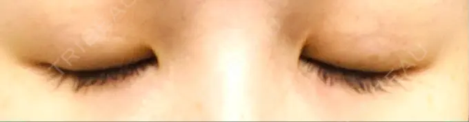 二重埋没 湘南美容クリニック 東京蒲田院 DAY 69 メイン用