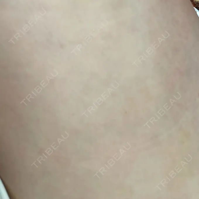 脂肪注入（額） / 脂肪注入（輪郭） 牧野美容クリニック DAY 21 メイン用