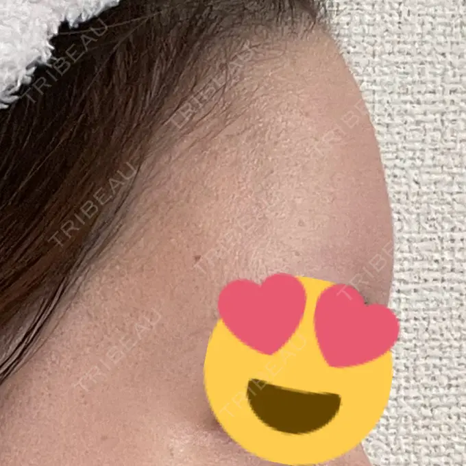 脂肪注入（額） / 脂肪注入（輪郭） 牧野美容クリニック DAY 21 メイン用
