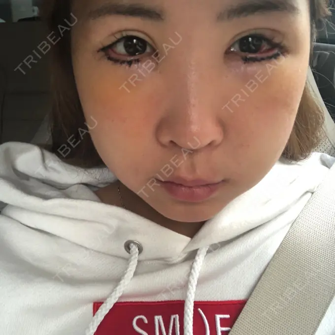 目尻切開 / タレ目形成・グラマラスライン（切開） 品川美容外科 横浜院（※品川スキンクリニック提携） DAY 3 メイン用