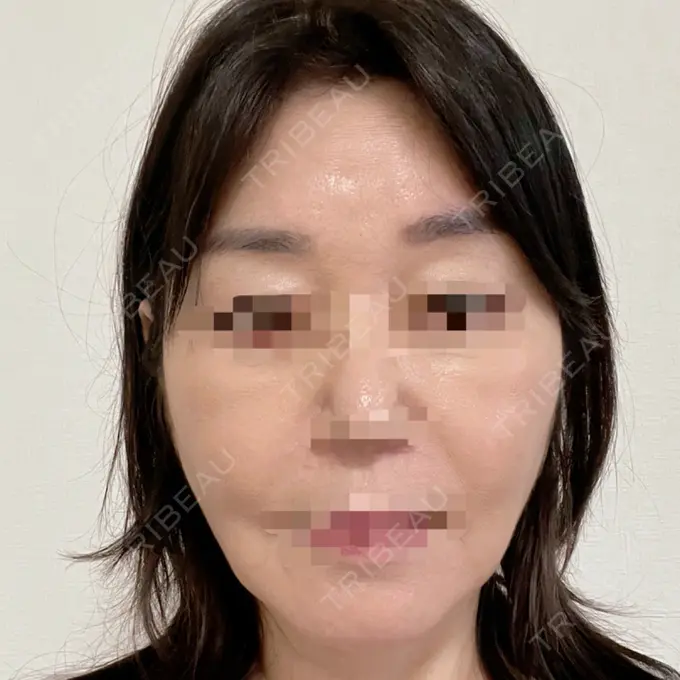 脂肪吸引（顔） / 切開リフト 恵聖会クリニック 京橋院 AFTER メイン用