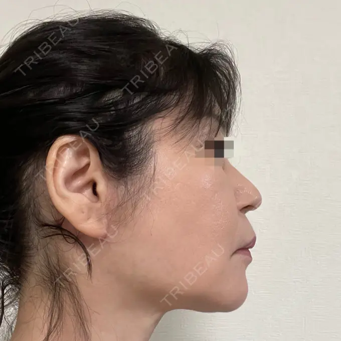 脂肪吸引（顔） / 切開リフト 恵聖会クリニック 京橋院 DAY 141 メイン用