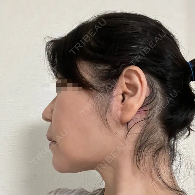 脂肪吸引（顔） / 切開リフト 恵聖会クリニック 京橋院 DAY 141 メイン用