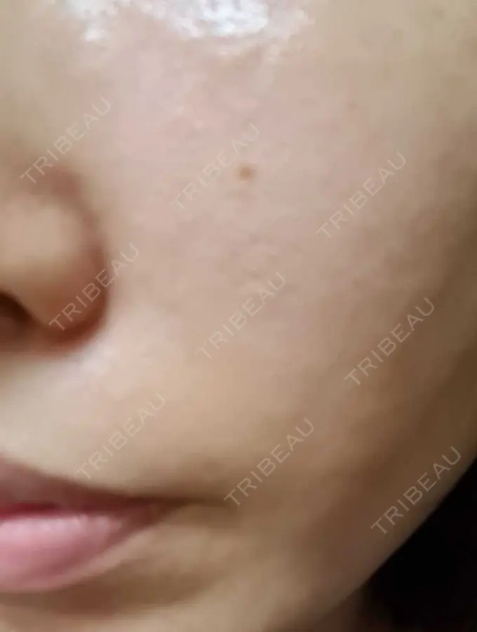 ベビーコラーゲン CLASSY 仙台美容外科・美容皮膚科 DAY 8 メイン用