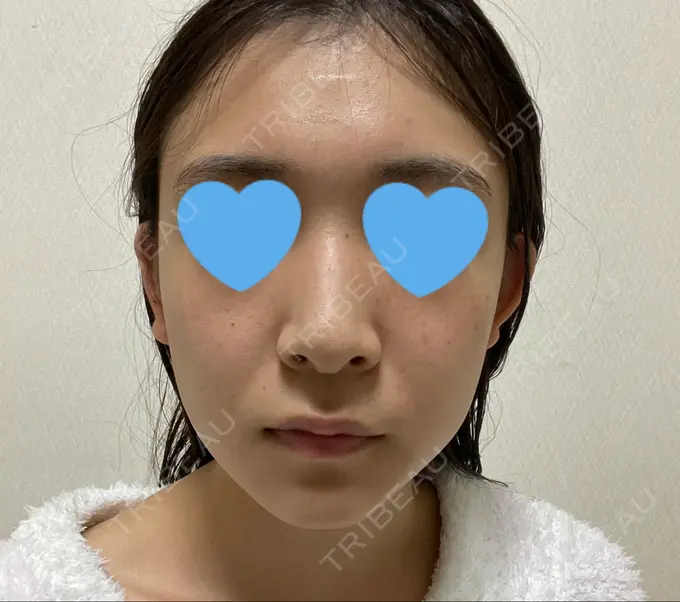 骨切り（あご） / 骨削り（エラ） / 骨削り（頬） / 脂肪吸引（顔） アーククリニック AFTER メイン用