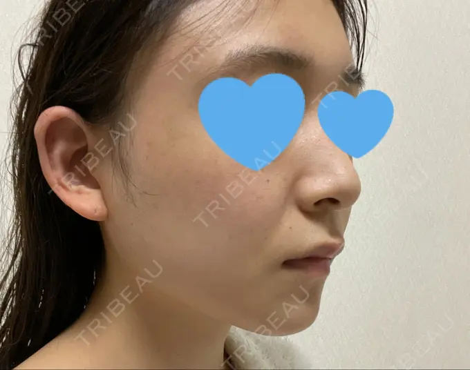 骨切り（あご） / 骨削り（エラ） / 骨削り（頬） / 脂肪吸引（顔） アーククリニック DAY 186 メイン用