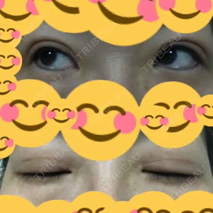 二重埋没 神戸元町ビューティークリニック DAY 92 メイン用