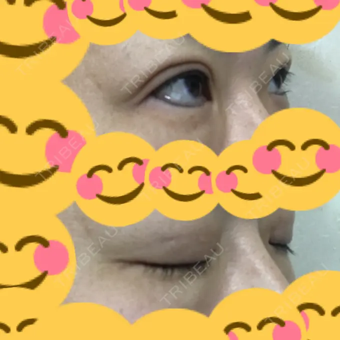 二重埋没 神戸元町ビューティークリニック DAY 92 メイン用