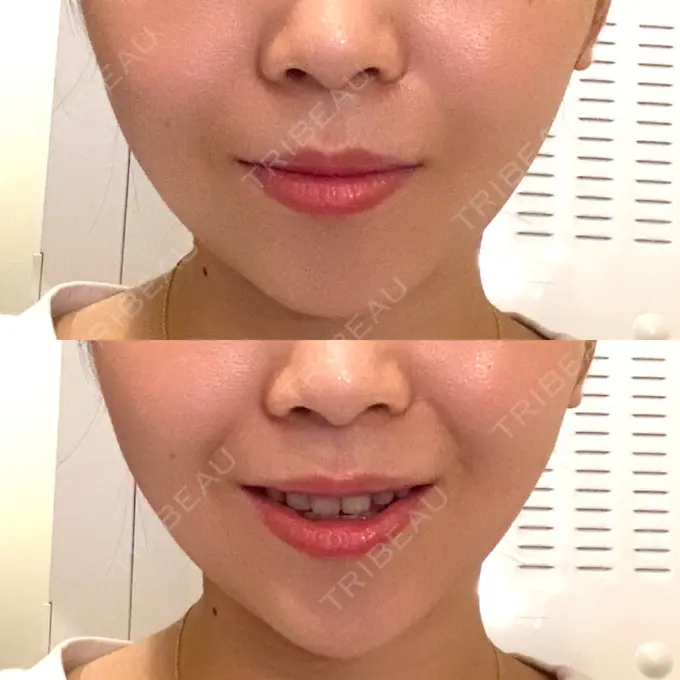 糸リフト / 脂肪吸引（顔） / ボトックス（あご） WOM CLINIC GINZA （ワム クリニック ギンザ） AFTER メイン用