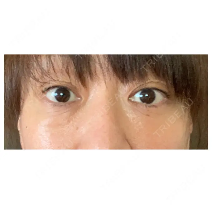 下まぶたたるみ取り / 下まぶたの脂肪取り セオリークリニック AFTER メイン用