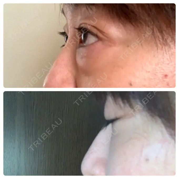 下まぶたたるみ取り / 下まぶたの脂肪取り セオリークリニック DAY 123 メイン用