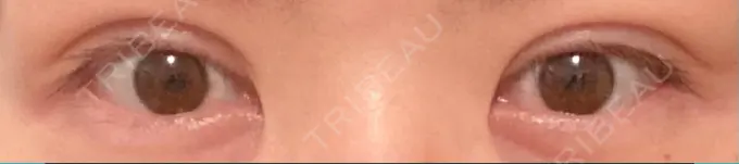 二重切開 / 上まぶたの脂肪取り 城本クリニック 豊橋院 DAY 305 メイン用