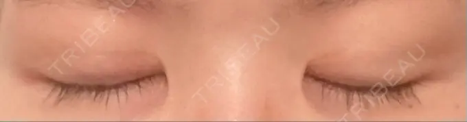 二重切開 / 上まぶたの脂肪取り 城本クリニック 豊橋院 DAY 305 メイン用