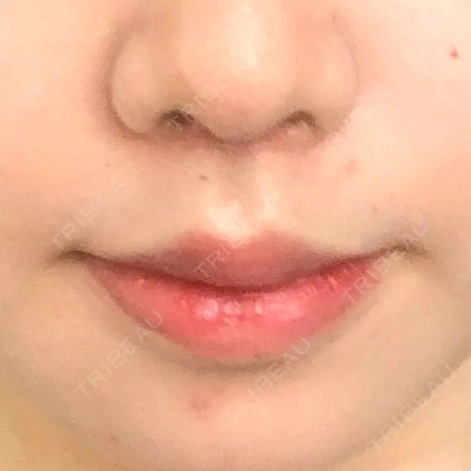 人中短縮 / ボトックス（口角） 新宿ラクル美容外科クリニック 新宿院 DAY 32 メイン用