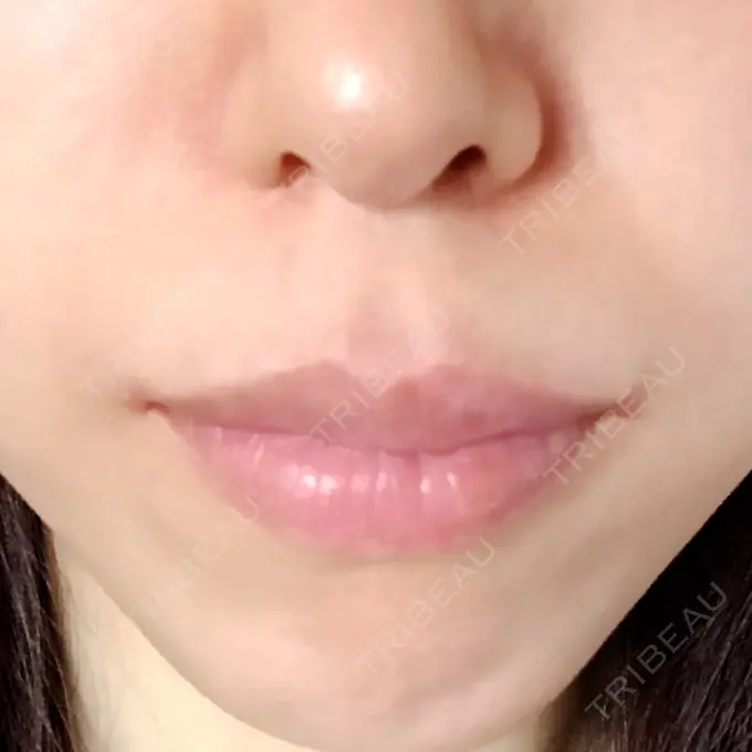 口角挙上 / その他（口元） eクリニック 金沢本院 AFTER メイン用