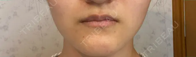 ボトックス（エラ・小顔） TCB東京中央美容外科 福岡天神院 DAY 21 メイン用