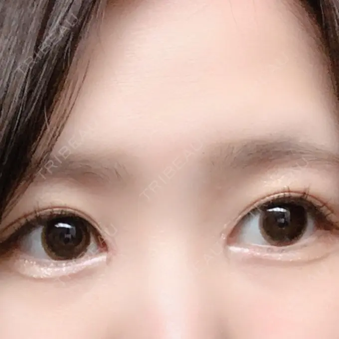 二重埋没 / 二重切開 / 矯正（ワイヤー） 湘南美容クリニック 橋本院 DAY 35 メイン用