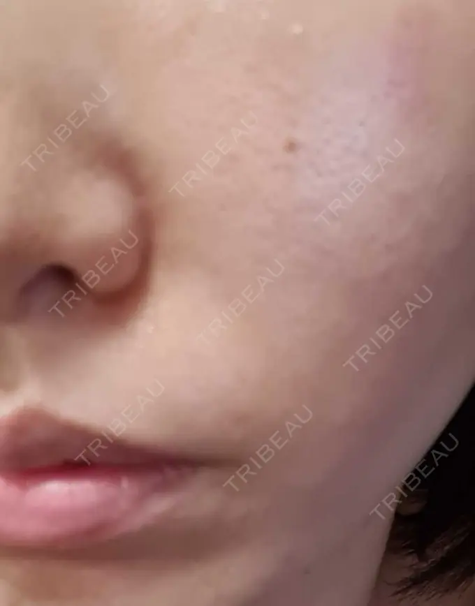 ベビーコラーゲン CLASSY 仙台美容外科・美容皮膚科 DAY 11 メイン用