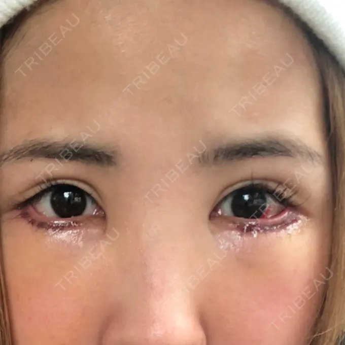 目尻切開 / タレ目形成・グラマラスライン（切開） 品川美容外科 横浜院（※品川スキンクリニック提携） DAY 4 メイン用