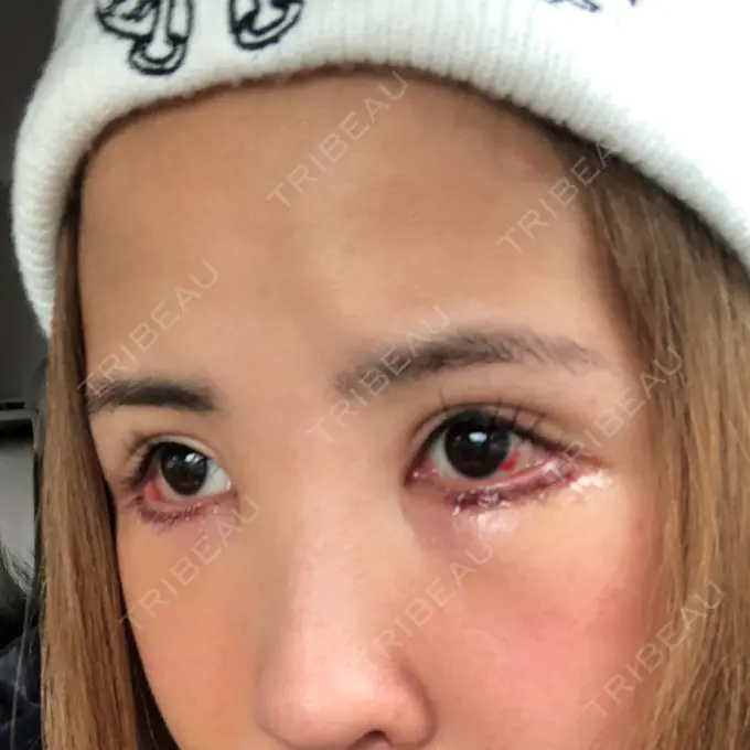 目尻切開 / タレ目形成・グラマラスライン（切開） 品川美容外科 横浜院（※品川スキンクリニック提携） DAY 4 メイン用