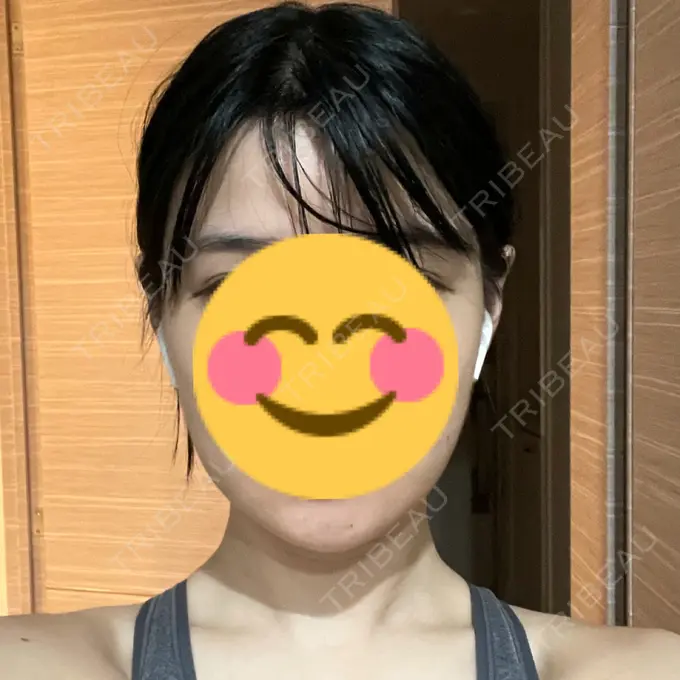 骨切り（あご） / 骨削り（エラ） / 骨削り（頬） よこはまエーブクリニック AFTER メイン用